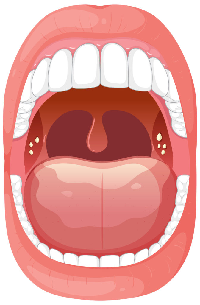 how to get rid of tonsil stones