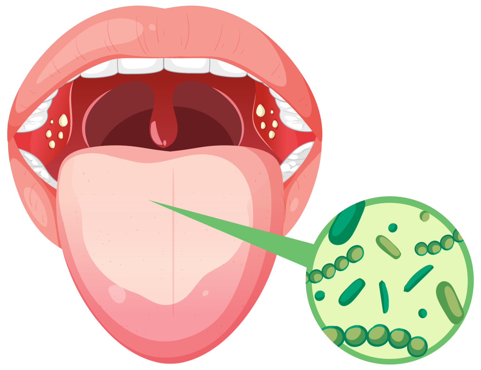How to get rid of tonsil stones